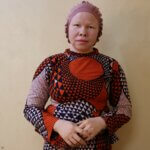 A women with Albinism looks straight in the camera. She wears a colorful dress.