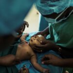 Baby umgeben von Ärzten und medizinischem Personal kurz vor Augen OP